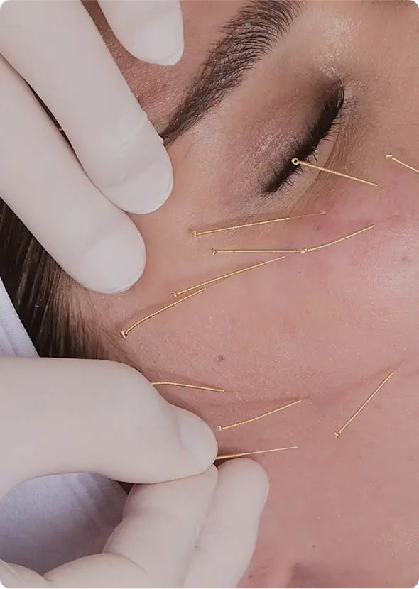 acupuntura para arrugas del entrecejo tratamiento facial